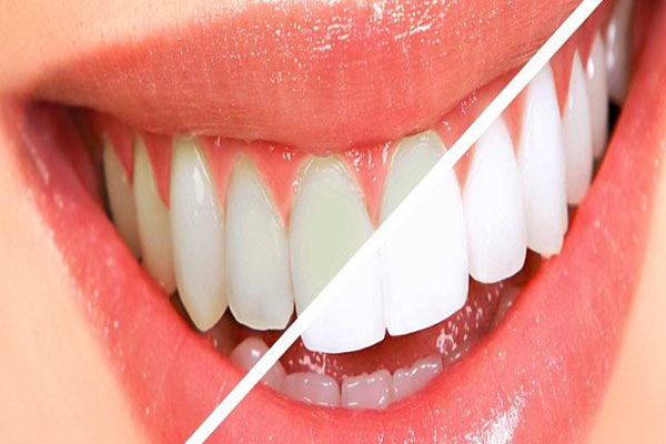 پودر زاج برای سفید کردن دندان ها